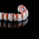 Full Mouth Dental Implants: Restoring Your Smile Completely